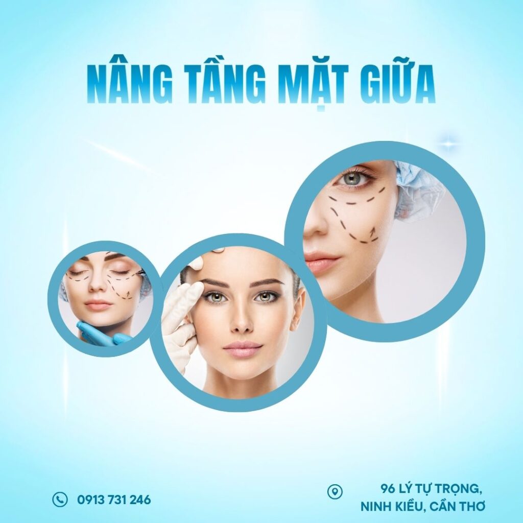 NÂNG TẦNG MẶT GIỮA CẮT MÍ DƯỚI