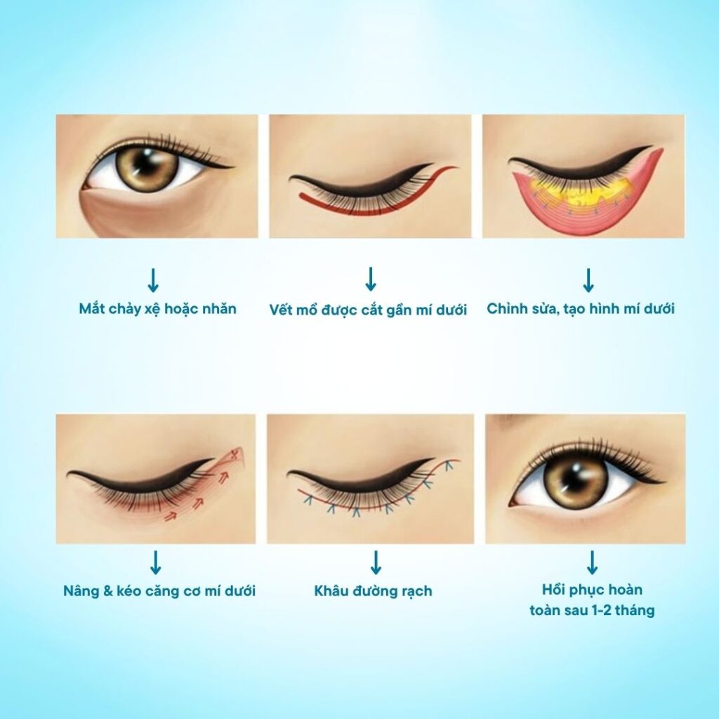 Cắt mí dưới Cần Thơ x Tái cấu trúc mỡ