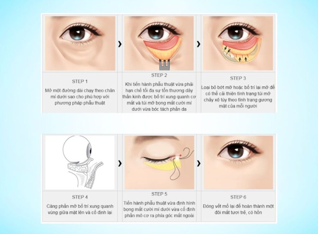 Cắt mí dưới Cần Thơ x Tái cấu trúc mỡ