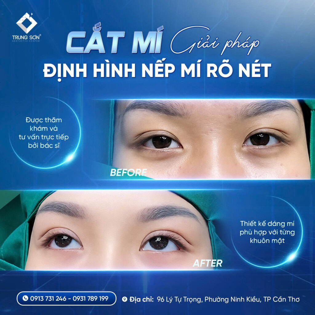Hình ảnh trước và sau khi cắt mí mắt tại Thẩm Mỹ Trung Sơn. Dáng mí được thiết kế phù hợp với từng khuôn mặt, giúp đôi mắt rõ nét và hài hòa hơn.