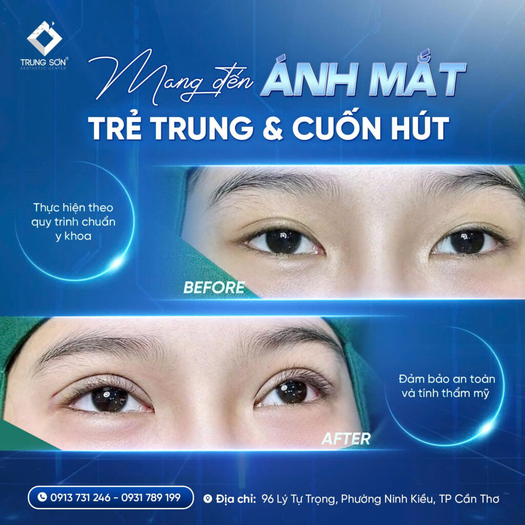 Kết quả thực tế sau khi cắt mí mắt giúp khách hàng sở hữu đôi mắt rõ nét, cân đối và trẻ trung hơn. Quy trình được thực hiện theo tiêu chuẩn chuyên môn tại Trung Sơn.
