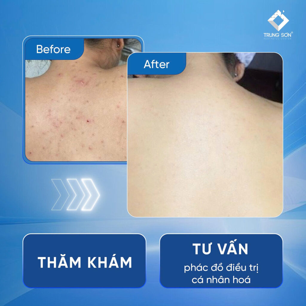 Hình ảnh kết quả điều trị mụn lưng trước và sau tại Phòng Khám Chuyên Khoa Da Liễu - Phẫu Thuật Thẩm Mỹ Trung Sơn. Khách hàng được thăm khám chuyên môn và tư vấn phác đồ điều trị cá nhân hóa theo tình trạng da thực tế, giúp hỗ trợ cải thiện mụn lưng, giảm viêm và nâng cao tính thẩm mỹ vùng da lưng.