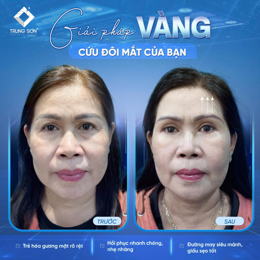 Hình ảnh khách hàng trước và sau khi nâng cung chân mày tại Trung Sơn. Sau thực hiện, vùng mắt trở nên tươi tắn hơn, hỗ trợ cải thiện tình trạng sụp mí và trẻ hóa khuôn mặt.