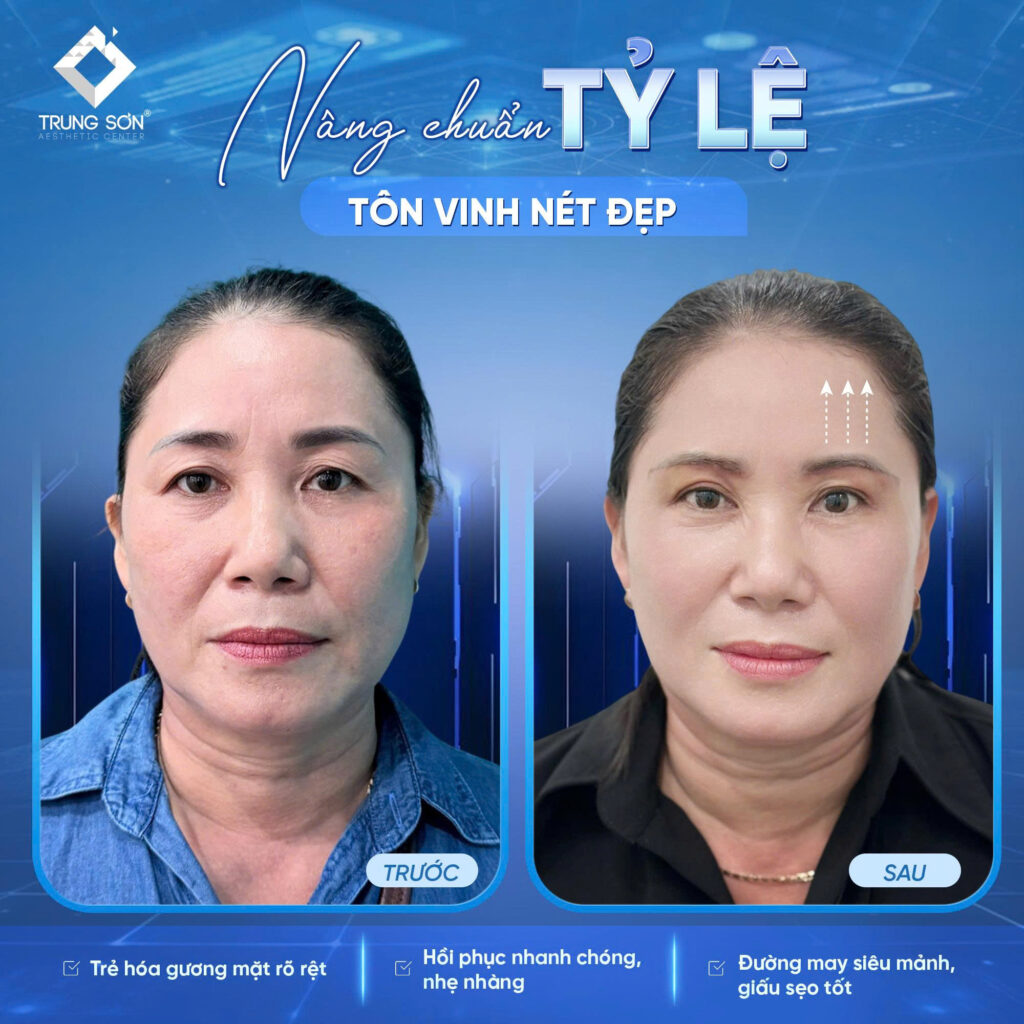 Kết quả thực tế sau nâng cung chân mày tại Thẩm Mỹ Trung Sơn giúp khách hàng sở hữu ánh nhìn trẻ trung, hài hòa và tự nhiên hơn. Bác sĩ tư vấn và xây dựng phương án phù hợp cho từng khách hàng.