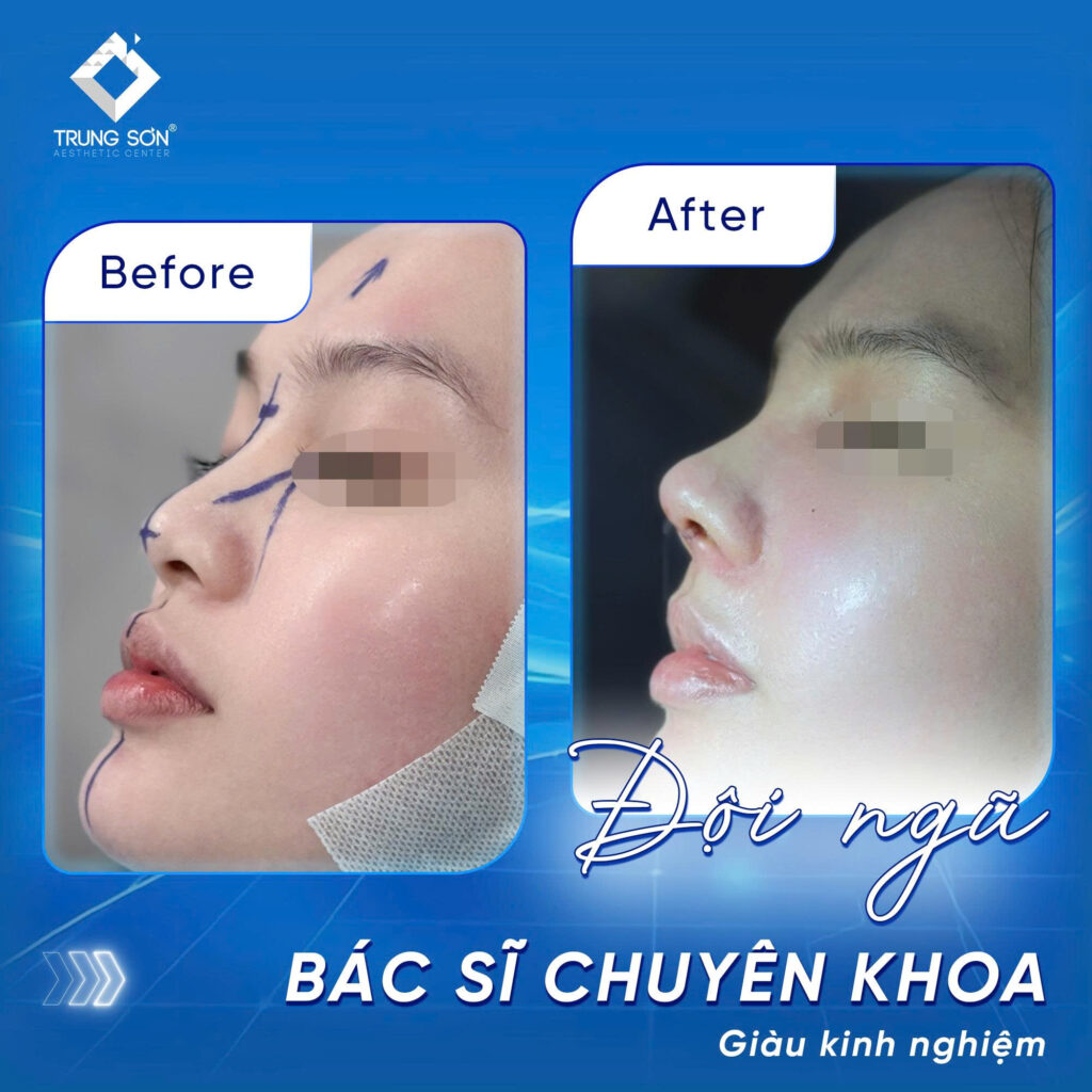 Hình ảnh trước và sau nâng mũi cấu trúc tại Trung Sơn, dáng mũi cao hơn, hài hòa với khuôn mặt.