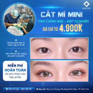 Cắt mí mini tại Thẩm mỹ Trung Sơn Cần Thơ giúp tạo mắt hai mí tự nhiên, ít xâm lấn, hồi phục nhanh, bác sĩ chuyên khoa trực tiếp thực hiện với chi phí chỉ từ 4.900K.