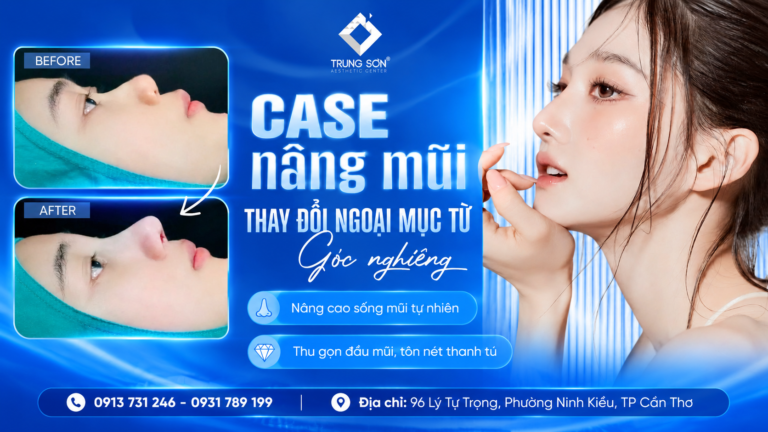Nâng Mũi Cần Thơ